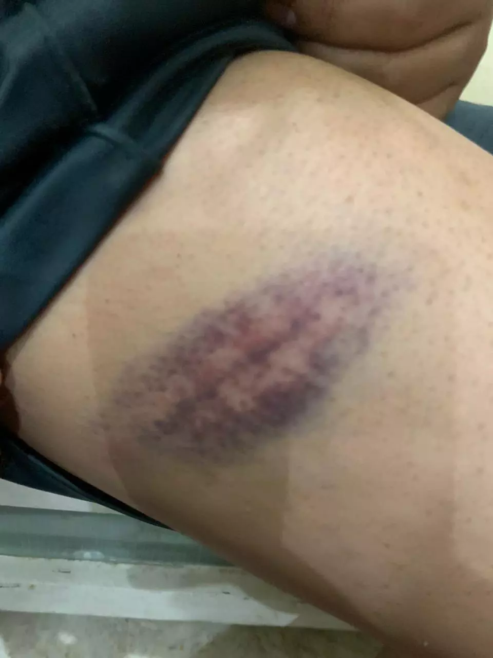 Teacher booked for caning 13-year-old student in Hyderabad