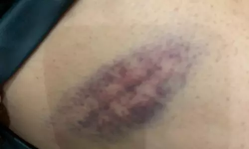 Teacher booked for caning 13-year-old student in Hyderabad