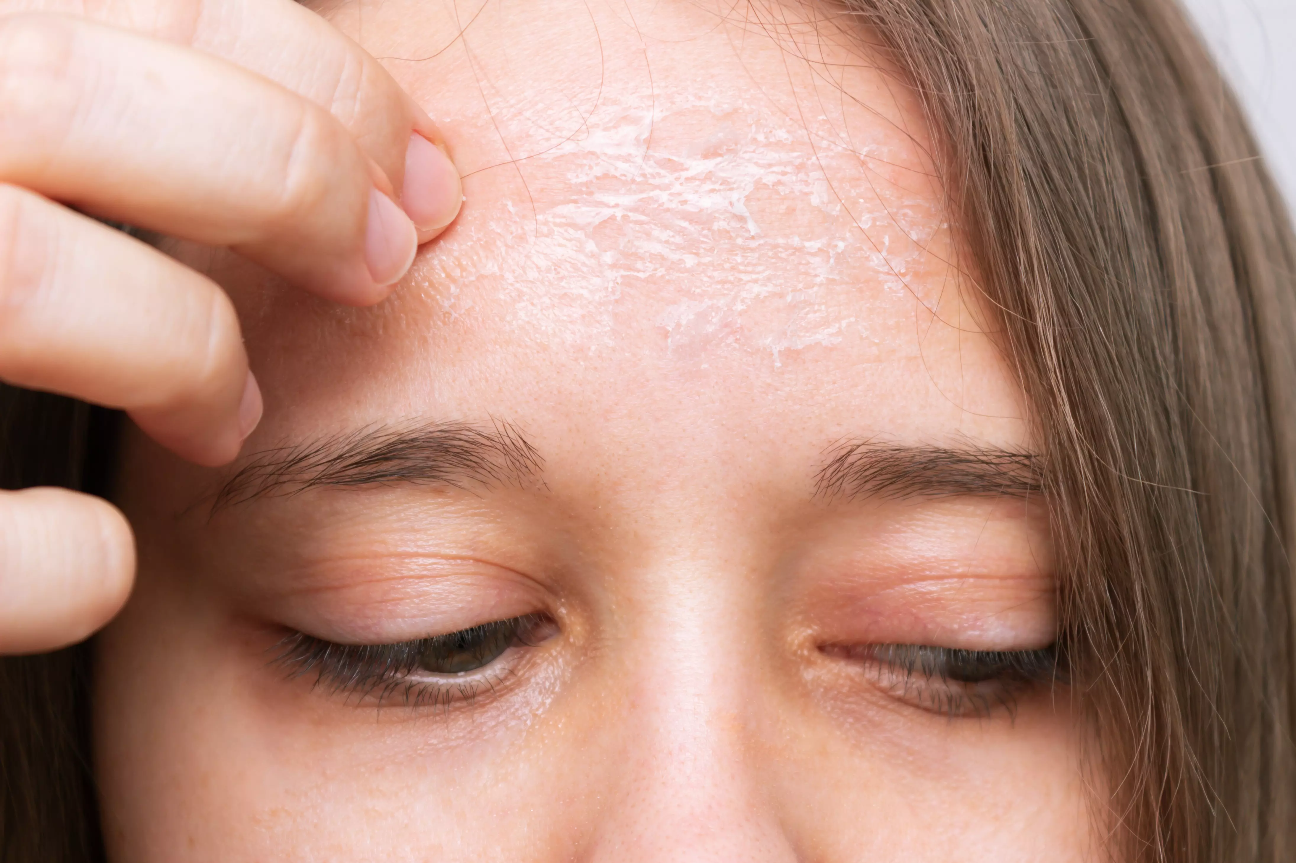 Stress management is one of key trigger factors for Psoriasis Stress management is one of key trigger factors for Psoriasis