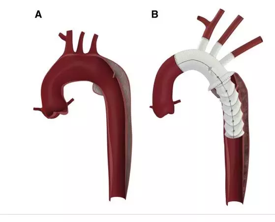 Myanmarese Operated Using Frozen Elephant Trunk Method