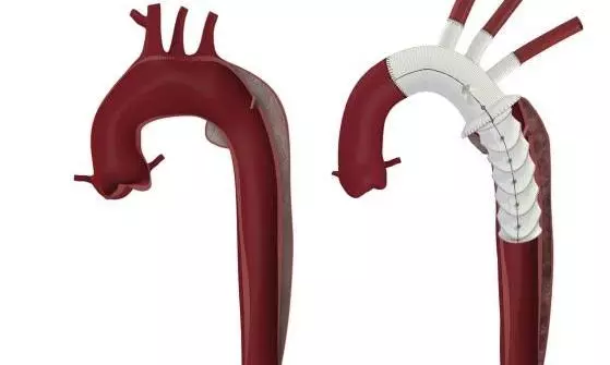 Myanmarese Operated Using Frozen Elephant Trunk Method Myanmarese Operated Using Frozen Elephant Trunk Method