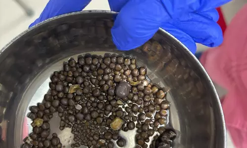 Surgical Milestone: 418 Kidney Stones Removed from Patient with 27% Kidney Function through Minimally Invasive Procedure to Save His Kidneys