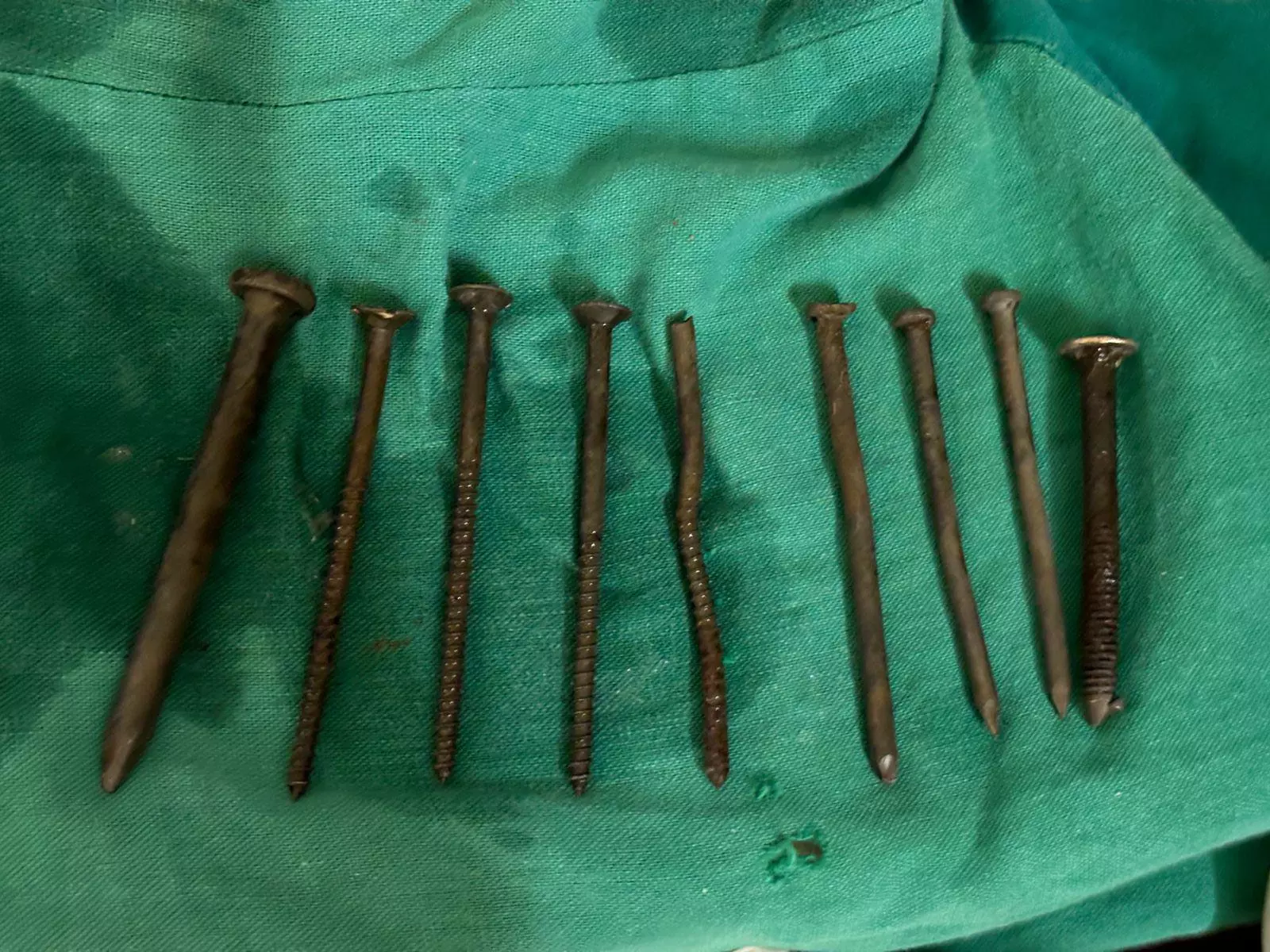 Doctors remove 9 iron nails from Cherlapally remand prisoner’s stomach