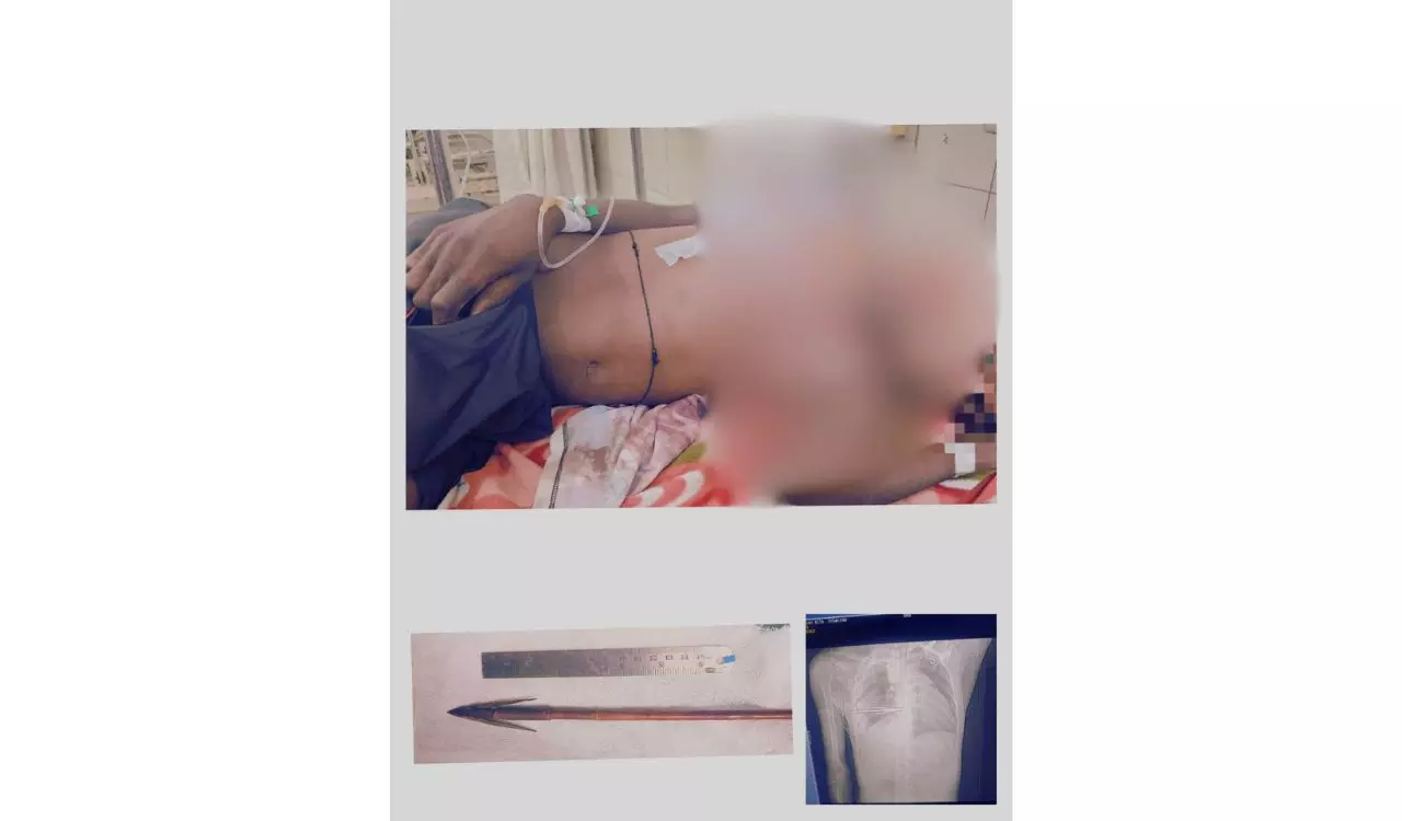 NIMS Doctors Perform Life-Saving Surgery, Rescues 26-Year-Old Tribal Man