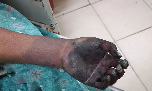 Fake Doctor’s Treatment Endangers Woman’s Hand in Warangal