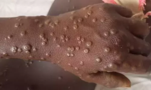 Suspected Mpox Case Reported in India, Patient Put Under Isolation