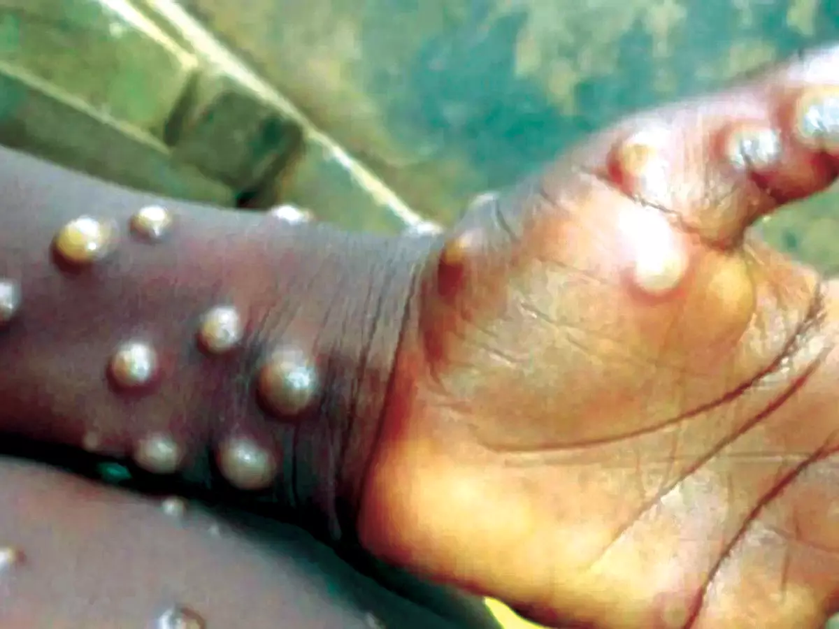 What is Mpox, Now Declared Global Health Emergency What is Mpox, Now Declared Global Health Emergency
