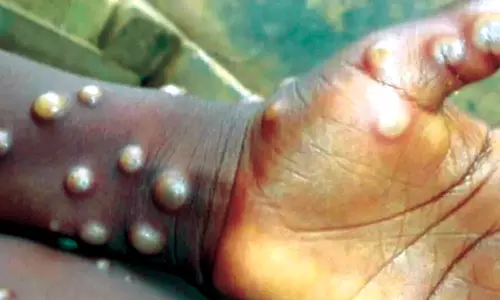 What is Mpox, Now Declared Global Health Emergency What is Mpox, Now Declared Global Health Emergency