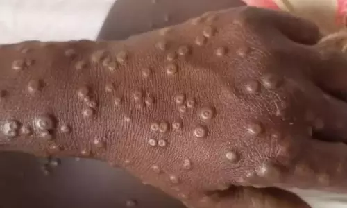 AP Geared to Deal With Mpox; Health Staff Keeping Close Watch on It