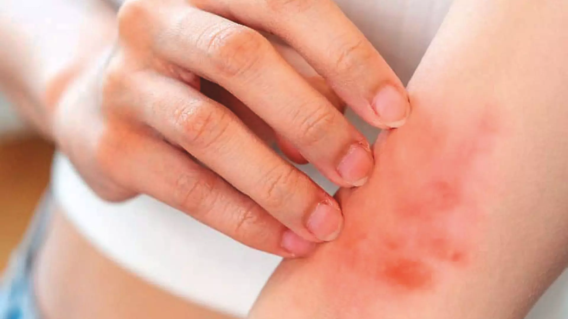 Is Mpox another pandemic? Is Mpox another pandemic?