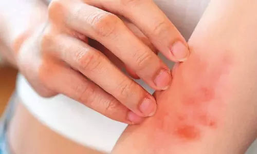 Is Mpox another pandemic?