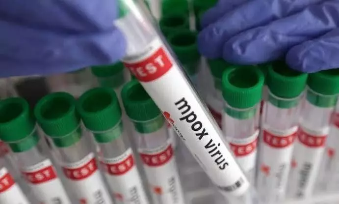 Suspected monkeypox infection reported from Malappuram in Kerala Suspected monkeypox infection reported from Malappuram in Kerala