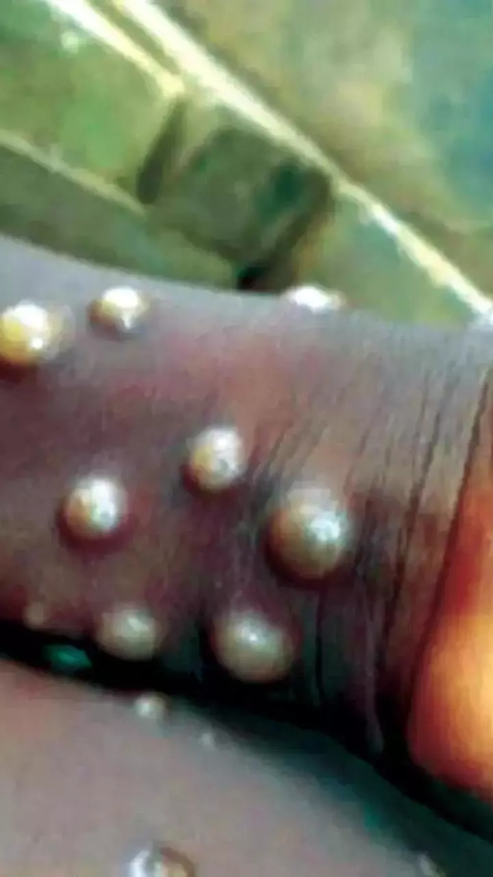 What is Mpox? Know Symptoms and Treatment
