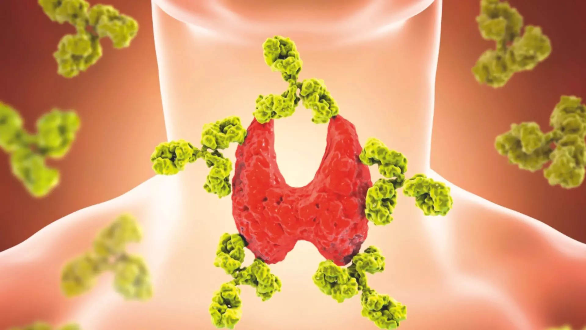 Hashimoto’s: The Thyroid Gland Health Scare Hashimoto’s: The Thyroid Gland Health Scare