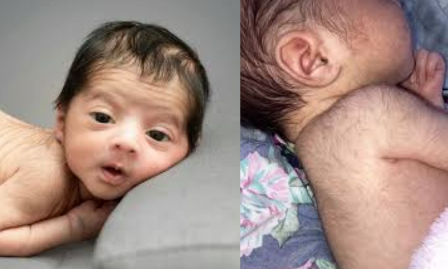 Why Some Babies Are Born Hairy Lanugo In Premature Babies Explained Why Some Babies Are Born Hairy Lanugo In Premature Babies Explained