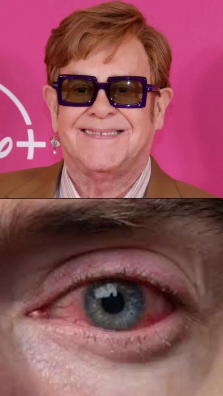 Experts Warn of Serious Eye Conditions, Urge Immediate Care