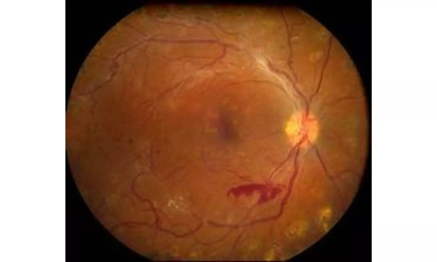 Review meeting addresses congenital eye diseases in children