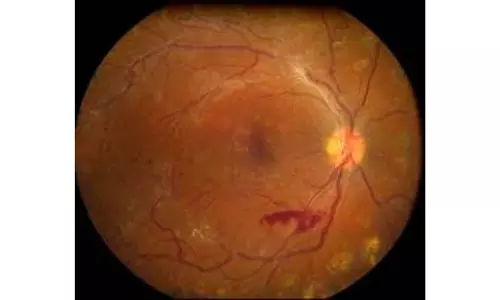 Review meeting addresses congenital eye diseases in children