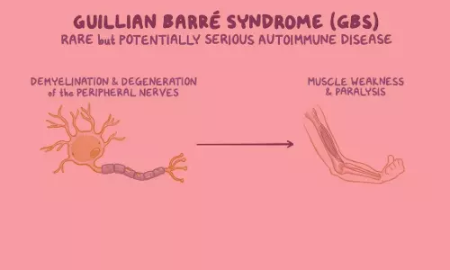 Telangana woman diagnosed with GBS disease, first known case in state