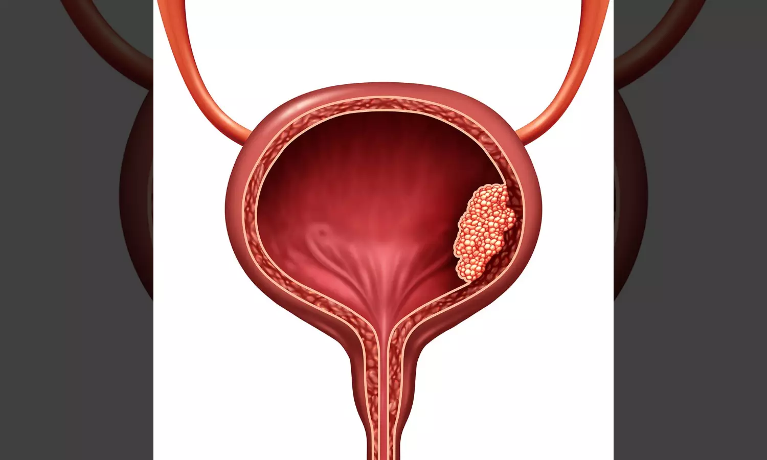 Bladder Cancer Awareness: Risk Factors, Symptoms, and Treatment