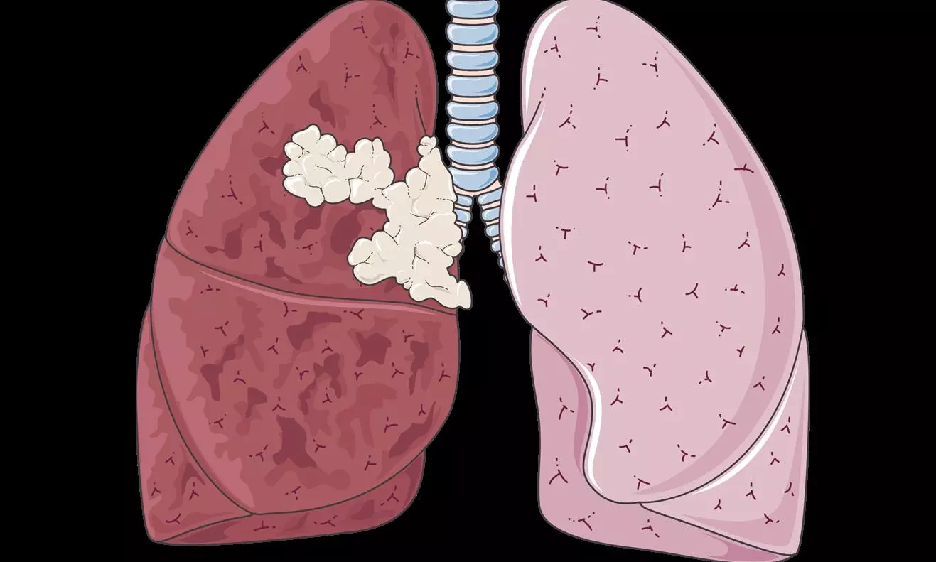 Air Pollution Leads to Lung Cancers