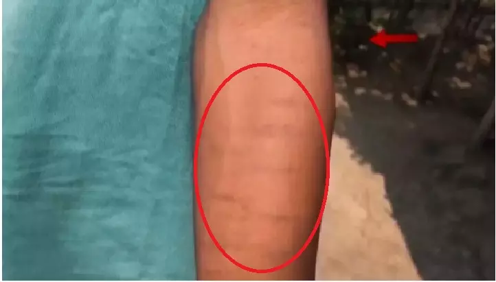Odisha: Seniors slash Class 6 student’s hand, rub salt into wounds