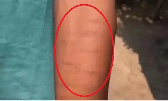 35 Students in Chhattisgarh School Inflict Injuries On Wrist, Probe Ordered 35 Students in Chhattisgarh School Inflict Injuries On Wrist, Probe Ordered