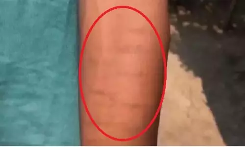 35 Students in Chhattisgarh School Inflict Injuries On Wrist, Probe Ordered