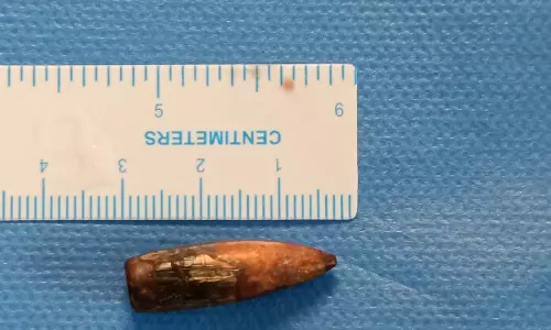 CARE Hospitals Successfully Performs Rare Bullet Removal Brain Surgery on International Patient