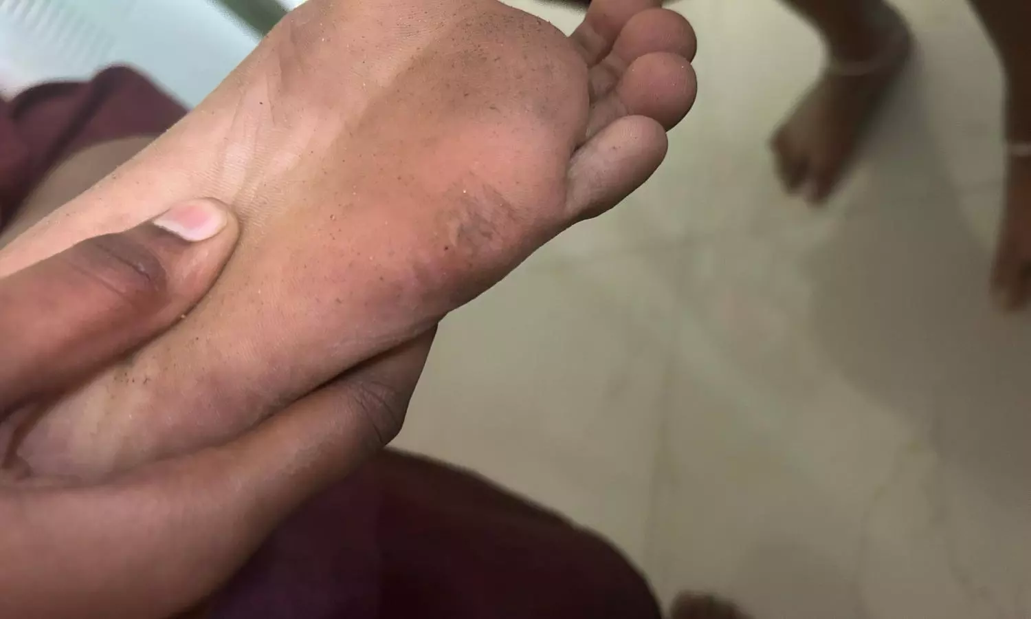 Rat Attack Injures 10 Female Students at Anantapur College Hostel