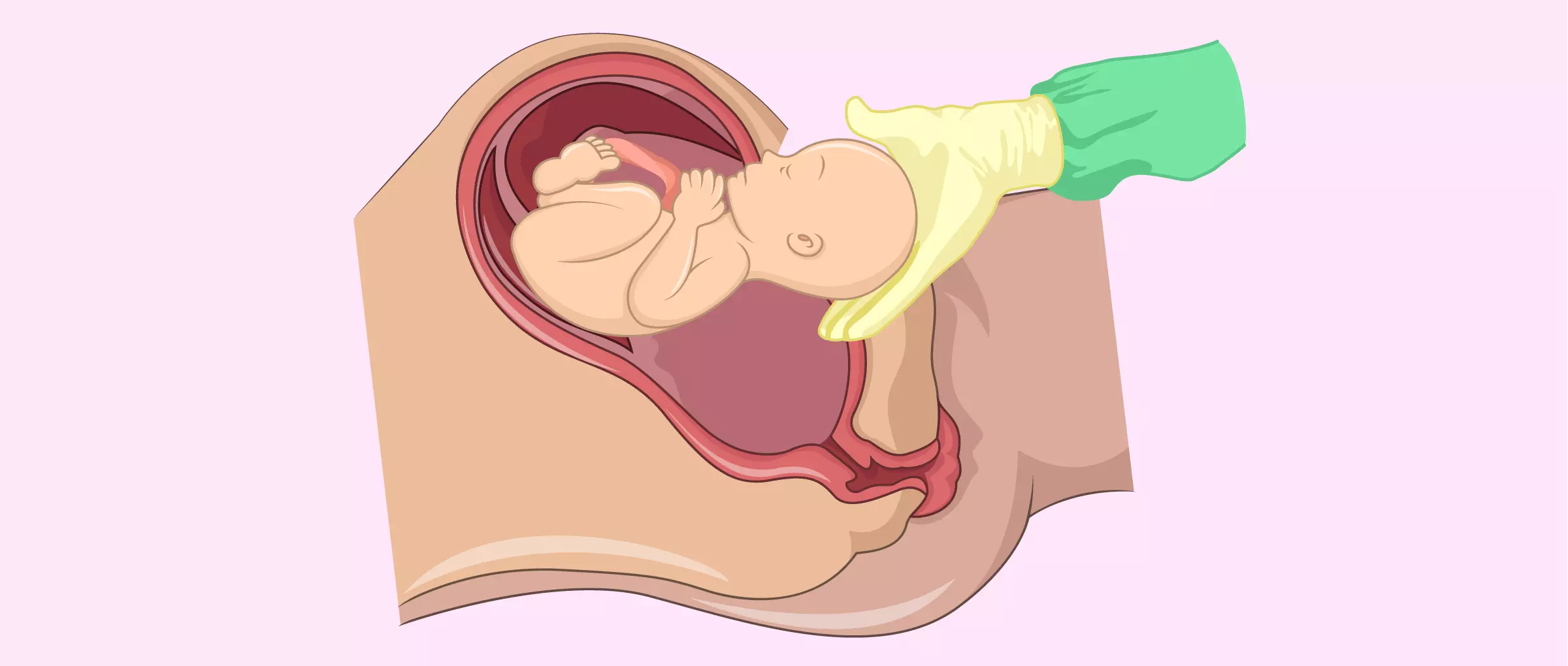 The Rise of C-Sections: When is it Necessary and What are the Risks?