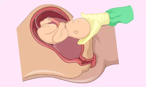The Rise of C-Sections: When is it Necessary and What are the Risks?