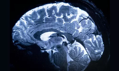China Joins US In Brain Implant Race With Clinical Trial
