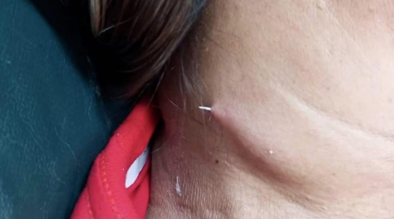 Fishbone Pierces Thai Woman's Neck Weeks After Swallowing