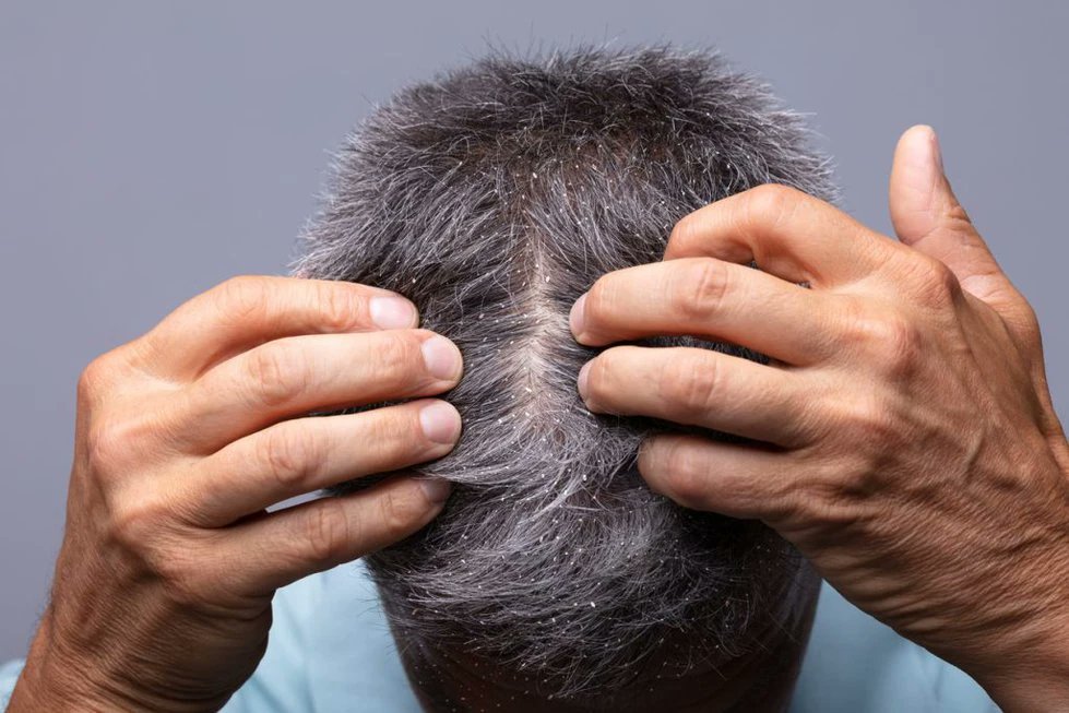Oily, Sticky Scalp: The Root Cause of Lifeless Hair