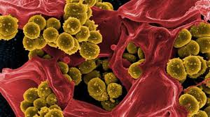Melioidosis Spreads in Madhya Pradesh, Experts Warn