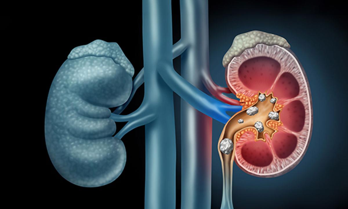 Kidney Stones: Causes, Symptoms, Diagnosis, and Treatment