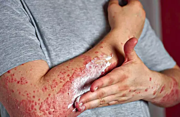 A Deadly Rash That Hides A Killer Threat