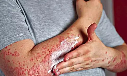 A Deadly Rash That Hides A Killer Threat