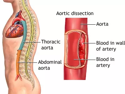 Study Exposes Gaps In Aortic Dissection Care