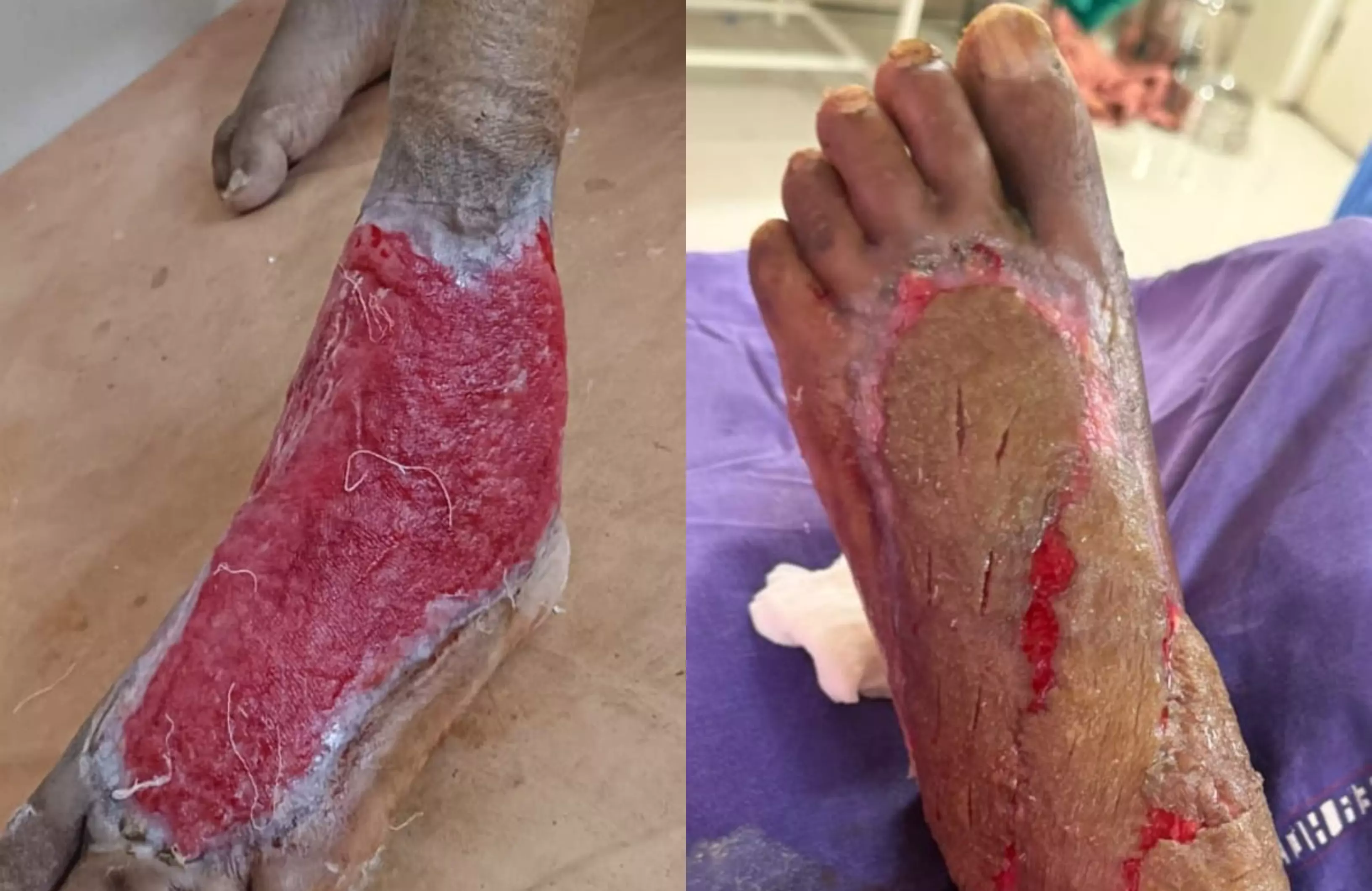 Rare Plastic Surgery Successfully Performed at Vemulawada Government Hospital Rare Plastic Surgery Successfully Performed at Vemulawada Government Hospital