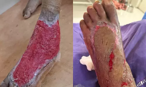 Rare Plastic Surgery Successfully Performed at Vemulawada Government Hospital