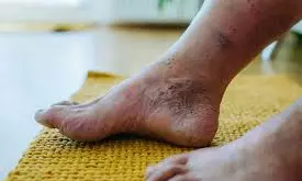 Nagaland University Researchers Find Plant Compound To Treat Diabetic Wound, Foot Ulcers