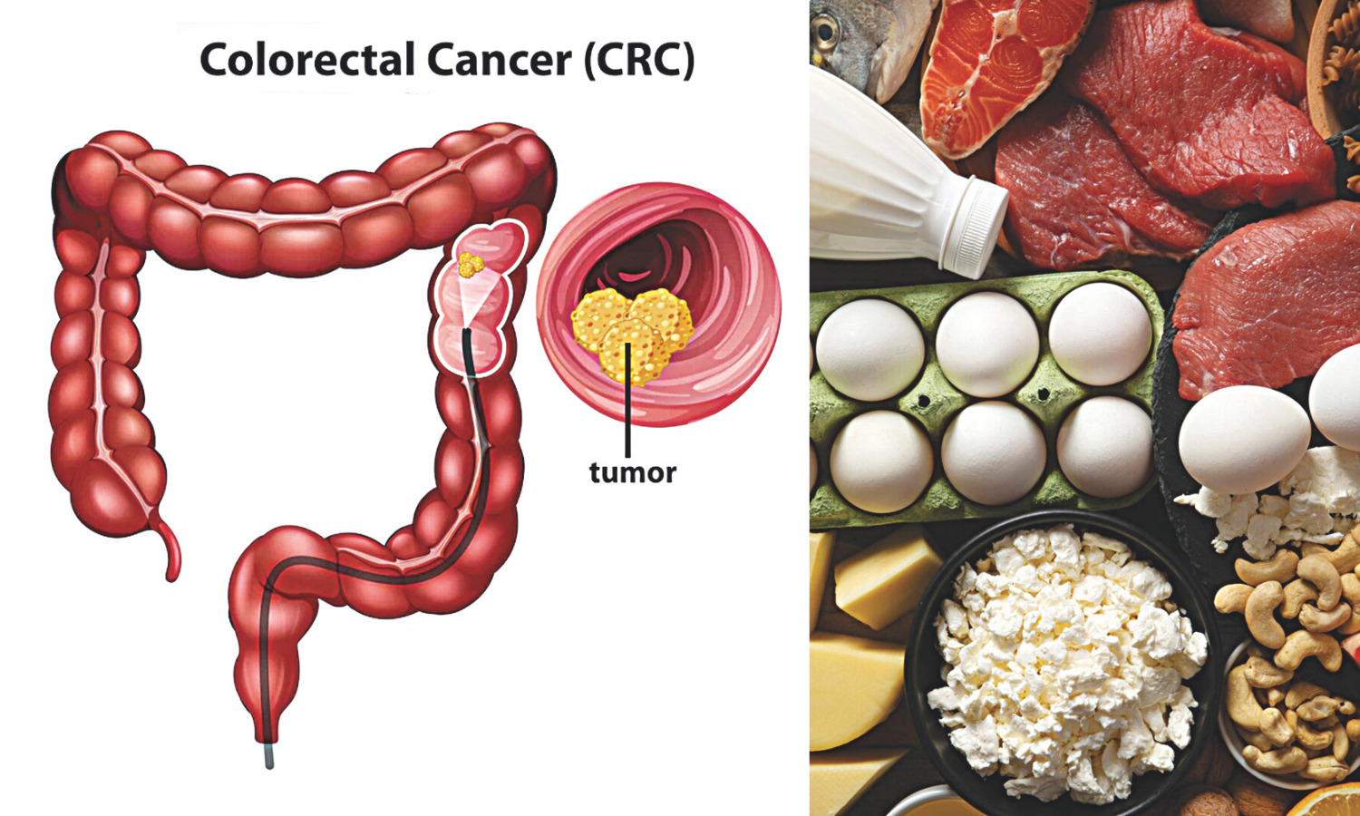 Early-Onset Colon Cancer Linked to Modern Dietary Habits
