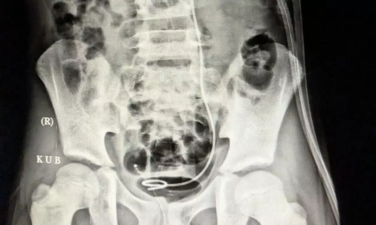 Rising Kidney Stone Incidences in Kids Caused by Poor Water Intake