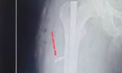 Kakinada Ortho Surgeon, Nurse Suspended After Blade Left Inside Patient