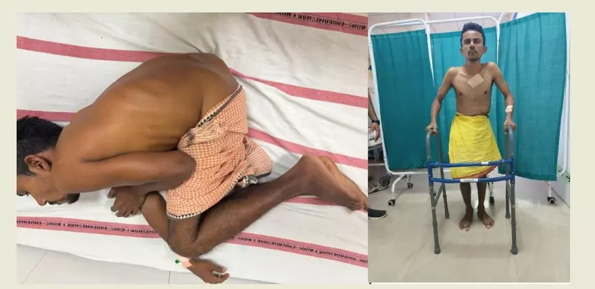 Odisha Man With Severe Spine, Hip Fusion Now Able to Stand and Walk After Complex AIIMS Surgeries Odisha Man With Severe Spine, Hip Fusion Now Able to Stand and Walk After Complex AIIMS Surgeries