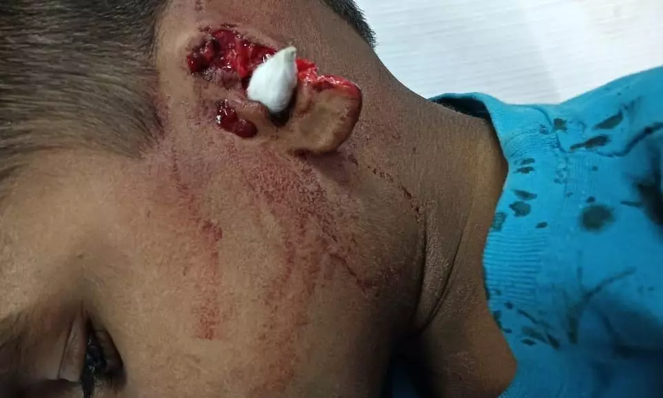 Stray Dog Attack Leaves Five-Year-Old Boy Seriously Injured In Kadiri Stray Dog Attack Leaves Five-Year-Old Boy Seriously Injured In Kadiri