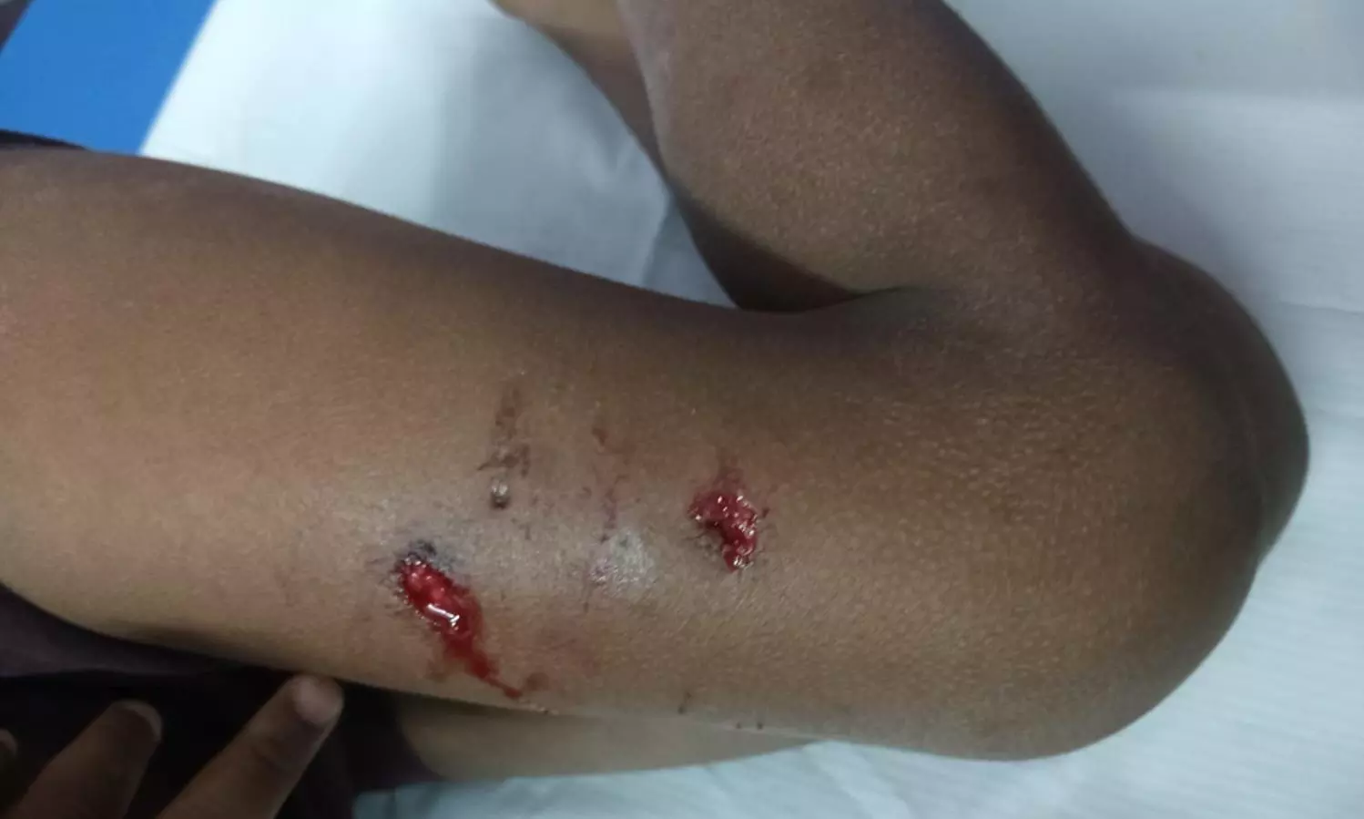 Stray Dog Attack Leaves Five-Year-Old Boy Seriously Injured In Kadiri Stray Dog Attack Leaves Five-Year-Old Boy Seriously Injured In Kadiri