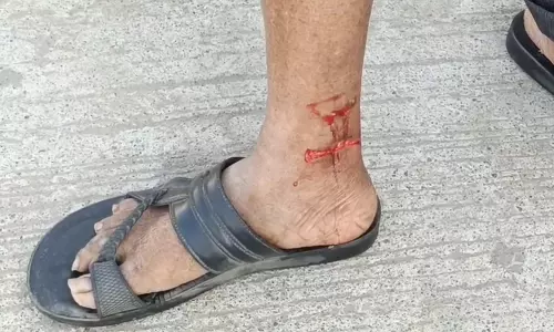 Stray Dog Goes on Rampage in Vemulawada; 21 Devotees Injured